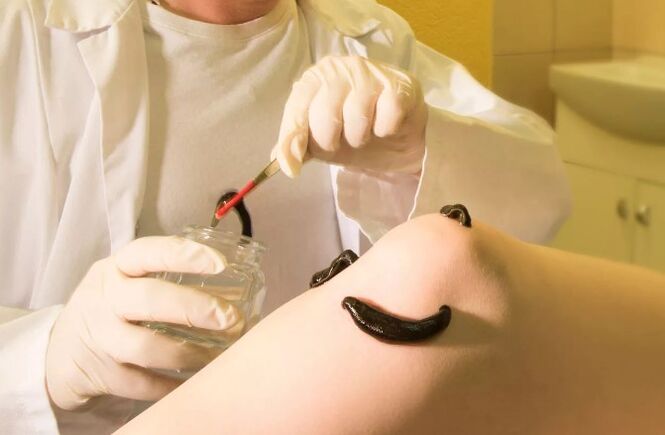 Hirudoterapia para varizes