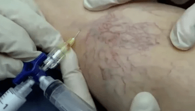 escleroterapia para varizes