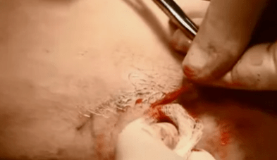 tipos de operações para remover veias varicosas