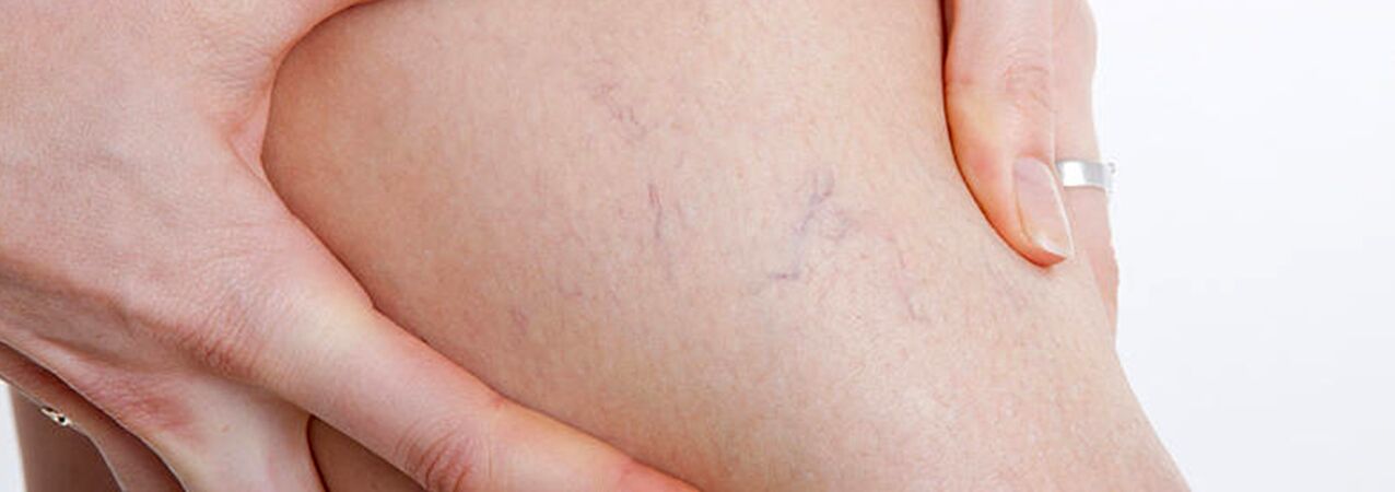 Veias em aranha com veias varicosas