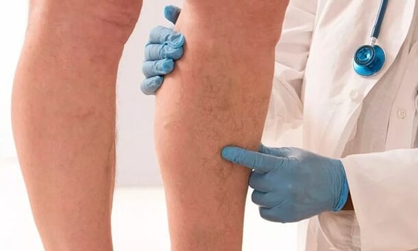 médico examina pernas em busca de varizes